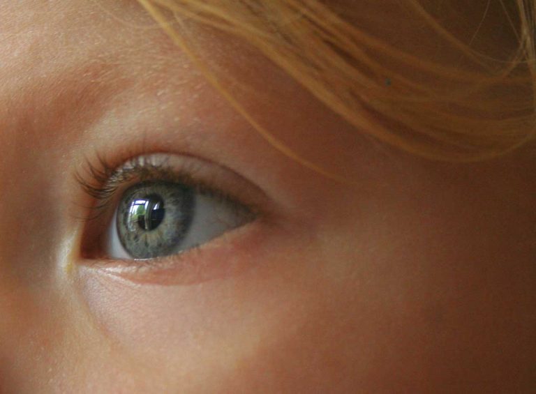 Pickel an der Schläfe geht nicht weg? So kannst Du ihn loswerden